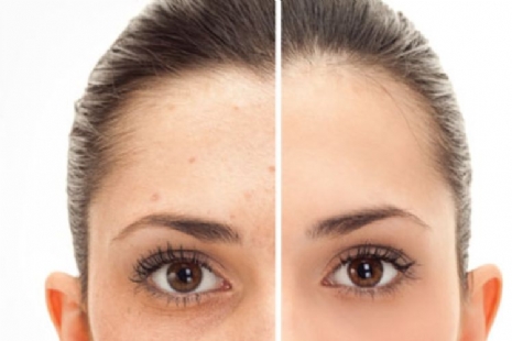 Producten voor anti pigmentvlekken Producten voor anti pigmentvlekken